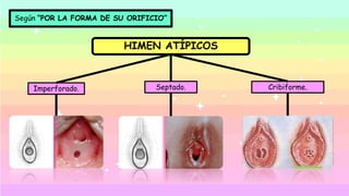 Según “POR LA FORMA DE SU ORIFICIO”
HIMEN ATÍPICOS
Imperforado. Septado. Cribiforme.
 