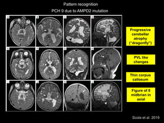 Posterior Fossa Malformations Dr Felice D'Arco | PPTX