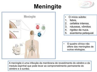 • O início súbito:
1. febre,
2. cefaléia intensa,
3. náuseas, vômitos
4. rigidez da nuca.
5. exantema petequial.
• O quadro clínico não
difere das meningites de
outras etiologias.
A meningite é uma infecção da membrana de revestimento do cérebro e da
medula espinhal que pode levar ao comprometimento permanente do
cérebro e à surdez.
Meningite
 