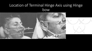 Location of Terminal Hinge Axis using Hinge
bow
 