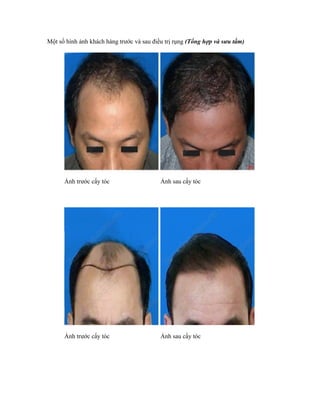 Một số hình ảnh khách hàng trước và sau điều trị rụng (Tổng hợp và sưu tầm)




      Ảnh trước cấy tóc                    Ảnh sau cấy tóc




      Ảnh trước cấy tóc                    Ảnh sau cấy tóc
 