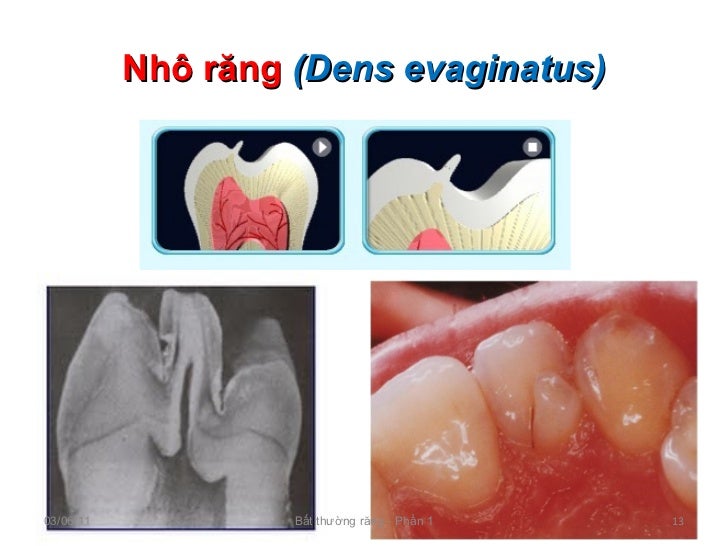 Hinh anh bat thuong rang phan 1