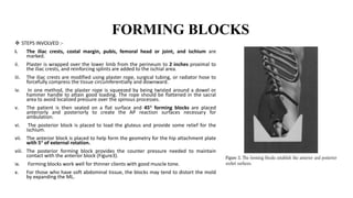 FORMING BLOCKS
 STEPS INVOLVED :-
i. The iliac crests, costal margin, pubis, femoral head or joint, and ischium are
marked.
ii. Plaster is wrapped over the lower limb from the perineum to 2 inches proximal to
the iliac crests, and reinforcing splints are added to the ischial area.
iii. The iliac crests are modified using plaster rope, surgical tubing, or radiator hose to
forcefully compress the tissue circumferentially and downward.
iv. In one method, the plaster rope is squeezed by being twisted around a dowel or
hammer handle to attain good loading. The rope should be flattened in the sacral
area to avoid localized pressure over the spinous processes.
v. The patient is then seated on a flat surface and 45° forming blocks are placed
anteriorly and posteriorly to create the AP reaction surfaces necessary for
ambulation.
vi. The posterior block is placed to load the gluteus and provide some relief for the
ischium.
vii. The anterior block is placed to help form the geometry for the hip attachment plate
with 5° of external rotation.
viii. The posterior forming block provides the counter pressure needed to maintain
contact with the anterior block (Figure3).
ix. Forming blocks work well for thinner clients with good muscle tone.
x. For those who have soft abdominal tissue, the blocks may tend to distort the mold
by expanding the ML.
 