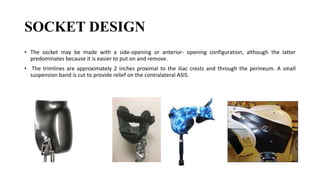SOCKET DESIGN
• The socket may be made with a side-opening or anterior- opening configuration, although the latter
predominates because it is easier to put on and remove.
• The trimlines are approximately 2 inches proximal to the iliac crests and through the perineum. A small
suspension band is cut to provide relief on the contralateral ASIS.
 