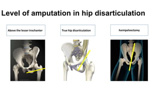 Level of amputation in hip disarticulation
Above the lesser trochanter True hip disarticulation hemipelvectomy
 