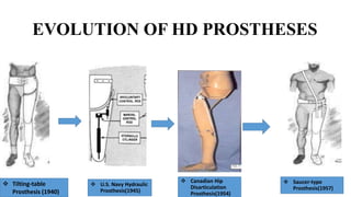 EVOLUTION OF HD PROSTHESES
 Tilting-table
Prosthesis (1940)
 U.S. Navy Hydraulic
Prosthesis(1945)
 Saucer-type
Prosthesis(1957)
 Canadian Hip
Disarticulation
Prosthesis(1954)
 