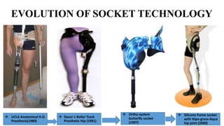  UCLA Anatomical H.D.
Prosthesis(1980)
 Dycor´s Roller Track
Prosthetic Hip (1991)
 Ortho-system
butterfly socket
(1997)
 Silicone frame socket
with Hipo-gross-Aqua
hip joint (2000)
EVOLUTION OF SOCKET TECHNOLOGY
 