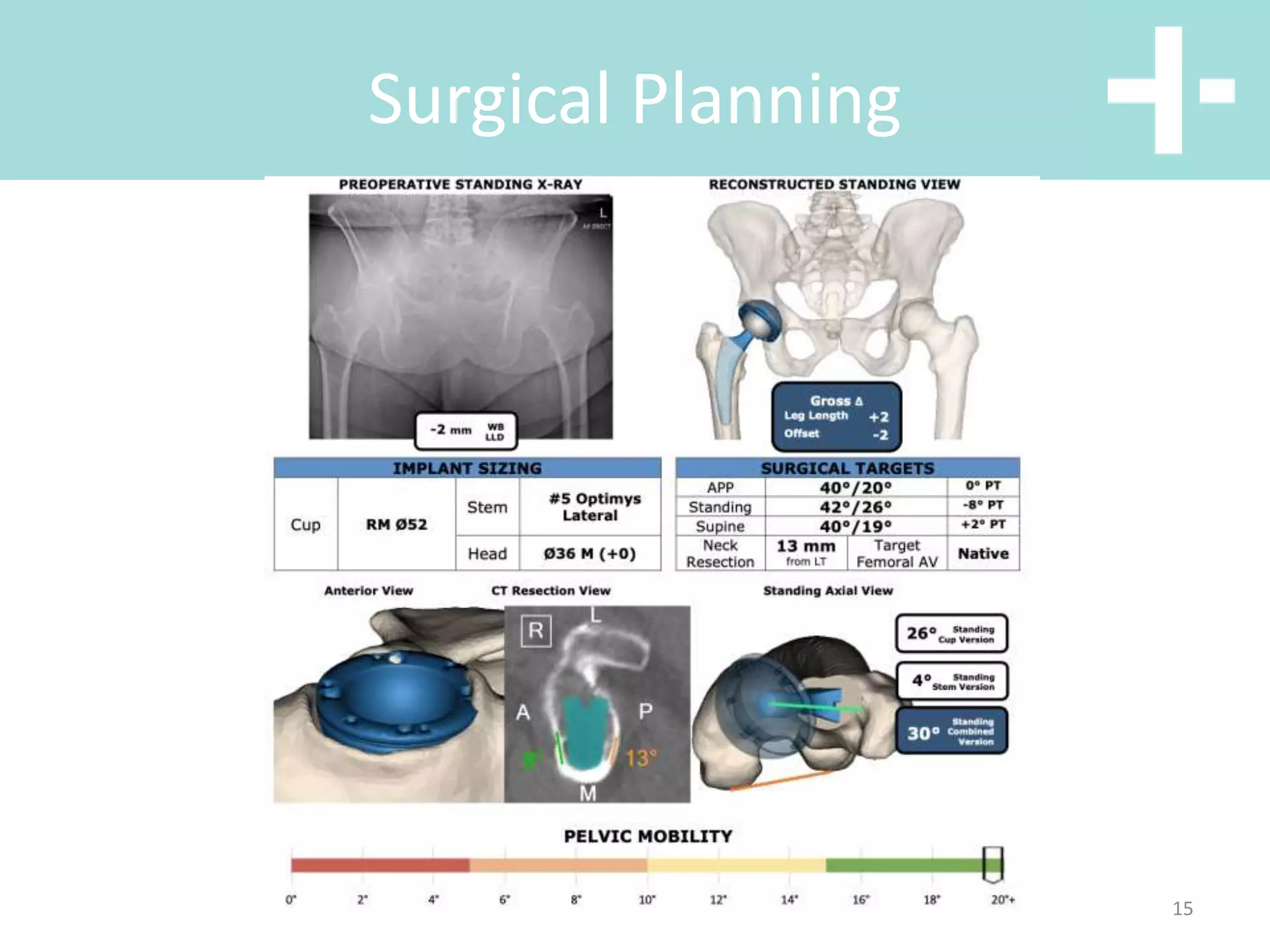 Hip anterior vs posterior total hip replacement | PPT