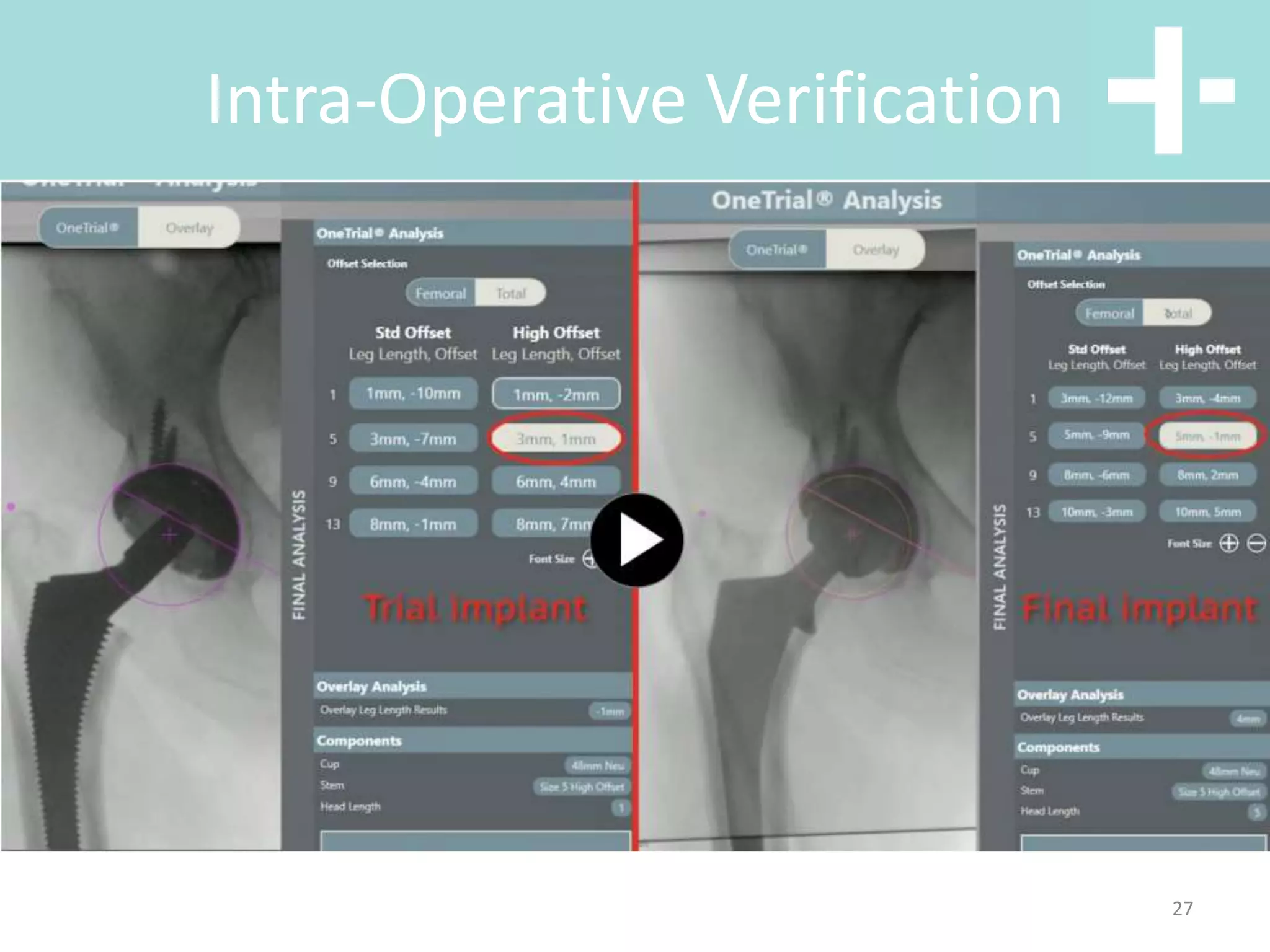 Hip anterior vs posterior total hip replacement | PPT