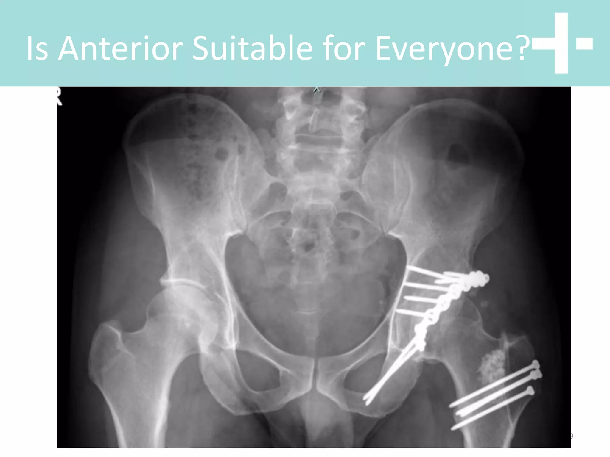 Hip anterior vs posterior total hip replacement | PPT