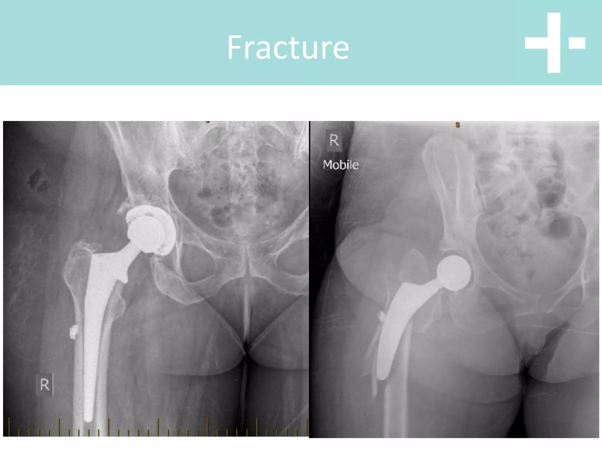 Hip anterior vs posterior total hip replacement | PPT