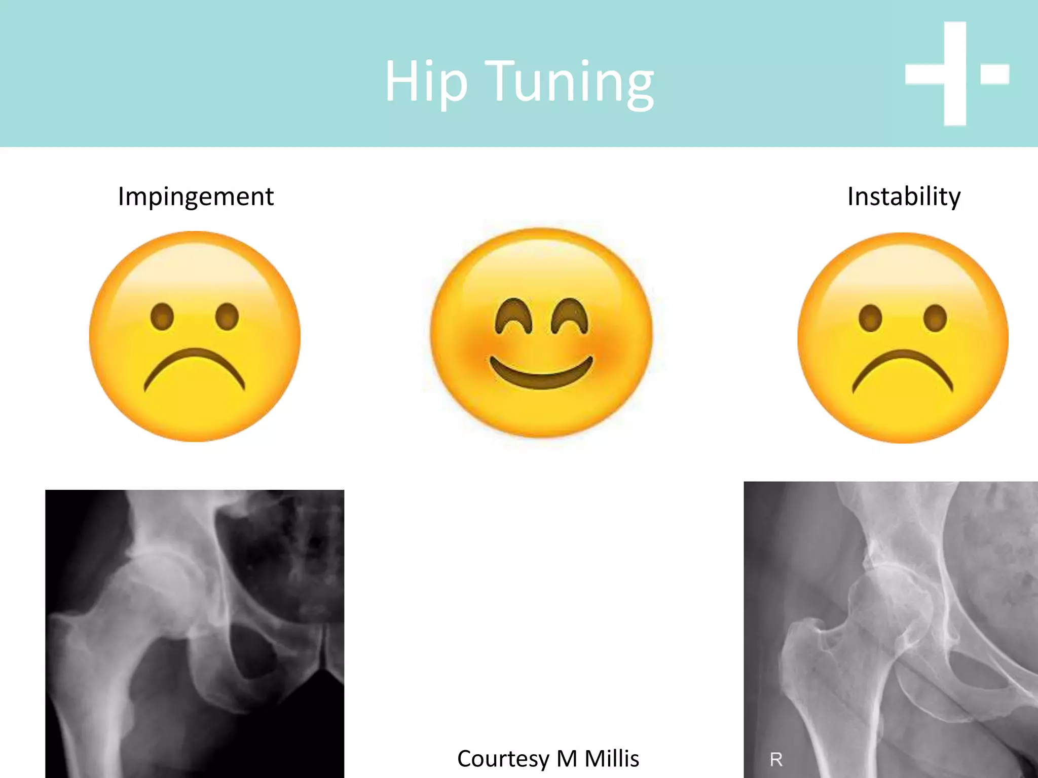 Hip anterior vs posterior total hip replacement | PPT