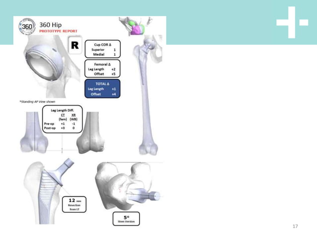 Hip anterior vs posterior total hip replacement | PPT