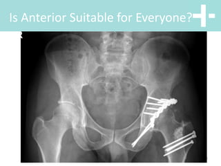 Hip anterior vs posterior total hip replacement | PPTX