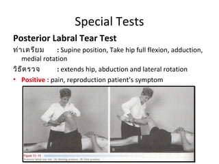 Special Tests 
Posterior Labral Tear Test 
ท่าเตรียม : Supine position, Take hip full flexion, adduction, 
medial rotation 
วิธีตรวจ : extends hip, abduction and lateral rotation 
• Positive : pain, reproduction patient’s symptom 
 