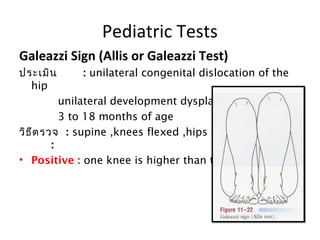 Pediatric Tests 
Galeazzi Sign (Allis or Galeazzi Test) 
ประเมิน : unilateral congenital dislocation of the 
hip 
unilateral development dysplasia of the hip 
3 to 18 months of age 
วิธีตรวจ : supine ,knees flexed ,hips flexed to 90°. 
: 
• Positive : one knee is higher than the other 
 