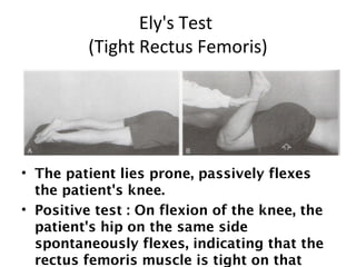 Ely's Test 
(Tight Rectus Femoris) 
• The patient lies prone, passively flexes 
the patient's knee. 
• Positive test : On flexion of the knee, the 
patient's hip on the same side 
spontaneously flexes, indicating that the 
rectus femoris muscle is tight on that 
 