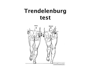 Trendelenburg 
test 
 