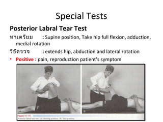 Special Tests 
Craig's Test 
ประเมิน : femoral anteversion or forward torsion of the 
femoral neck 
: degree of the femora...