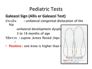 Pediatric Tests 
Telescoping Sign (Piston or Dupuytren's Test). 
ประเมิน : child with a dislocated hip 
ท่าเตรียม: supine ...