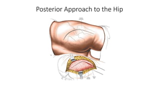 Moore Approach Hip Joint anatomy, surgical approches & AVN review | PPTX
