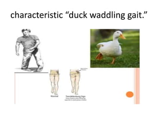 characteristic “duck waddling gait.”
 