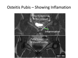 Osteitis Pubis – Showing Inflamation
 
