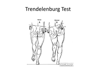 Trendelenburg Test
 