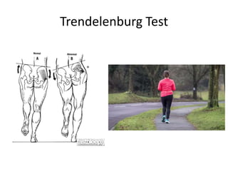 Trendelenburg Test
 