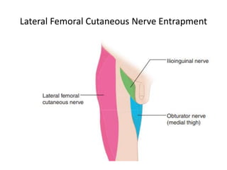 Lateral Femoral Cutaneous Nerve Entrapment
 