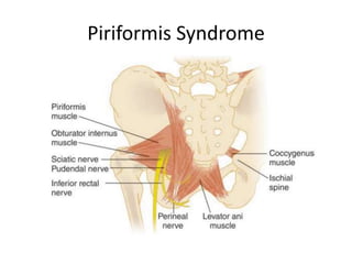 Piriformis Syndrome
 