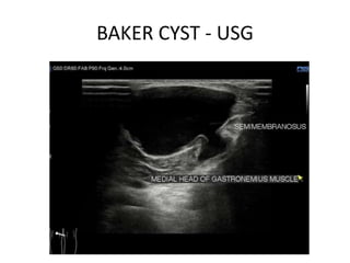 BAKER CYST - USG
 