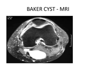 BAKER CYST - MRI
 