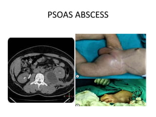 PSOAS ABSCESS
 
