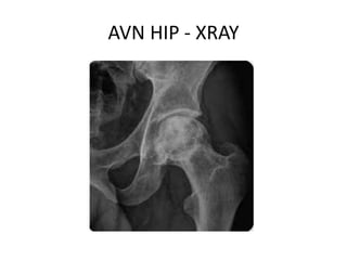 AVN HIP - XRAY
 