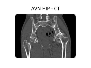 AVN HIP - CT
 