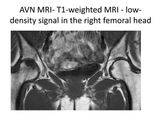 AVN MRI- T1-weighted MRI - low-
density signal in the right femoral head
 