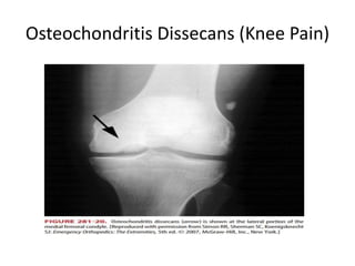 Osteochondritis Dissecans (Knee Pain)
 