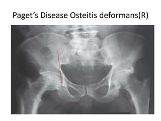 Paget’s Disease Osteitis deformans(R)
 