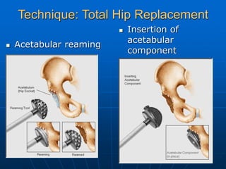 mode of failures in Hip and Knee Replacement.ppt