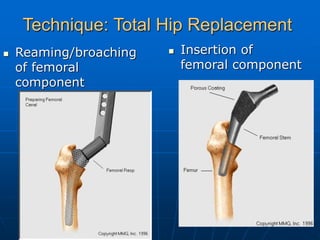 mode of failures in Hip and Knee Replacement.ppt