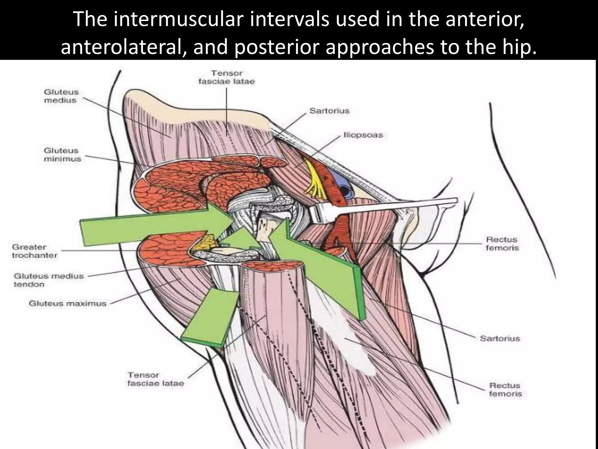 Surgical Approaches To Hip Joint PPTX