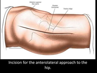 Surgical Approaches to Hip Joint | PPTX