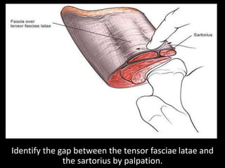 The deeper internervous plane lies between the rectus
femoris (femoral nerve) and the gluteus medius
(superior gluteal ner...
