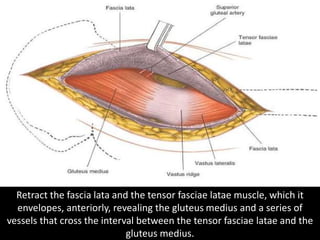 Bluntly dissect the fat pad off the anterior portion of the
joint capsule to expose it and the rectus femoris tendon.
 