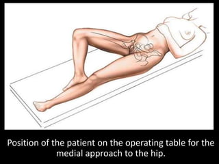 Anatomy of the medial approach to the hip. The thigh is abducted,
slightly flexed, and externally rotated. The plane of th...