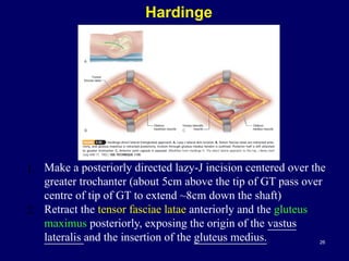 Hardinge
26
1. Make a posteriorly directed lazy-J incision centered over the
greater trochanter (about 5cm above the tip of GT pass over
centre of tip of GT to extend ~8cm down the shaft)
2. Retract the tensor fasciae latae anteriorly and the gluteus
maximus posteriorly, exposing the origin of the vastus
lateralis and the insertion of the gluteus medius.
 
