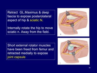48
Retract GL.Maximus & deep
fascia to expose posterolateral
aspect of hip & sciatic N.
Internally rotate the hip to move
sciatic n. Away from the field.
Short external rotator muscles
have been freed from femur and
retracted medially to expose
joint capsule
 