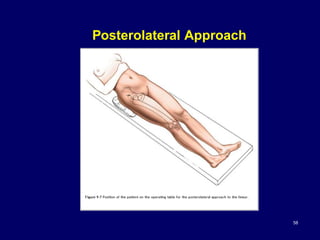 Posterolateral Approach
58
 