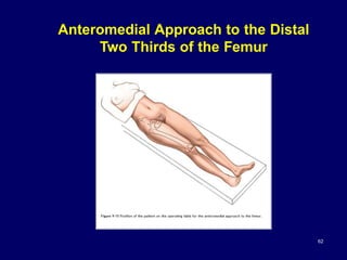 Anteromedial Approach to the Distal
Two Thirds of the Femur
62
 